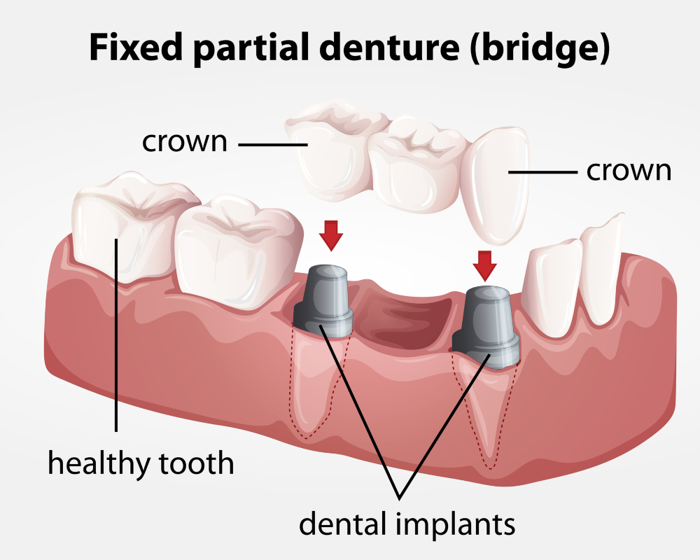 What are dental crowns