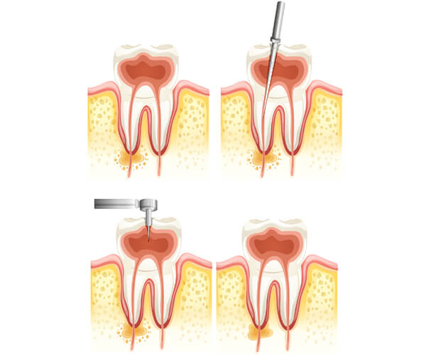 Root Canal
