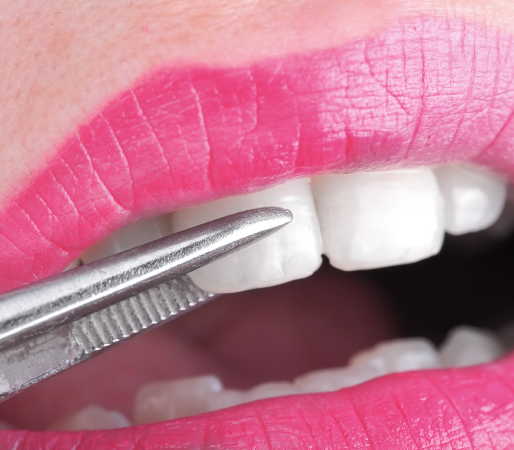 DENTAL VENEERS CARE