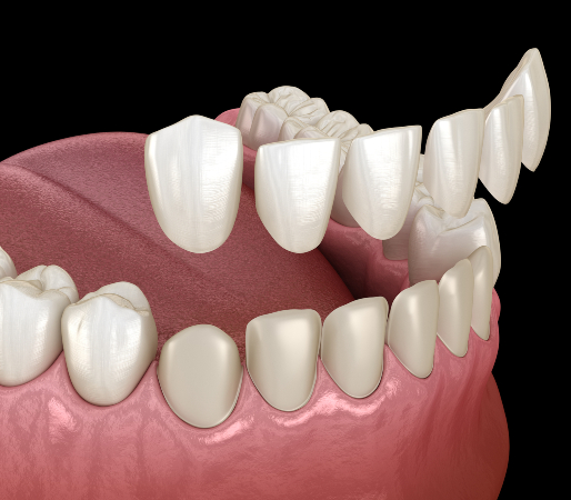 VENEERS APPLICATION AESTHETIC TEETH